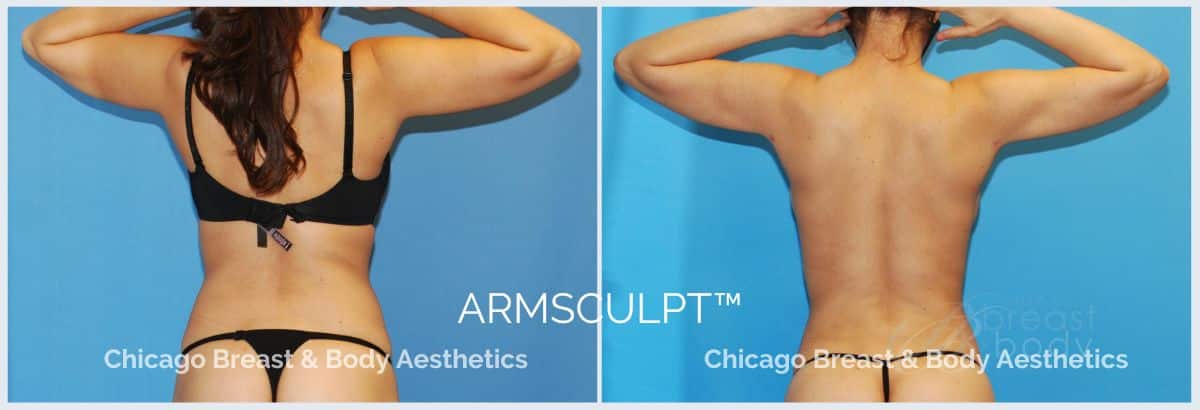 how much does arm liposuction cost Chicago, Illinois? Chicago Breast And Body
