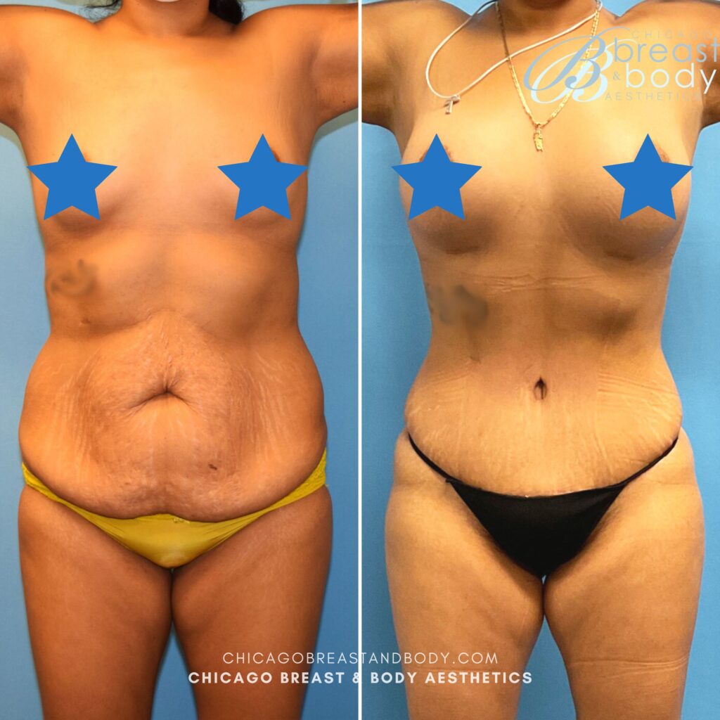 lipo or tummy tuck after c section Tummy Tuck after a C Section