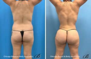 What is Hip Augmentation Surgery?
