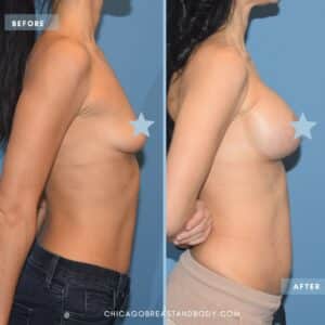 breast augmentation before and after photo Chicago breast and body aesthetics