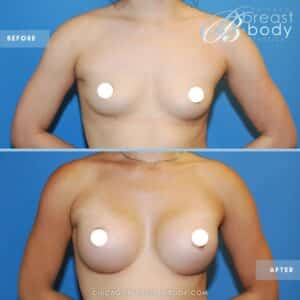 breast augmentation before after photo - Chicago breast and body aesthetics