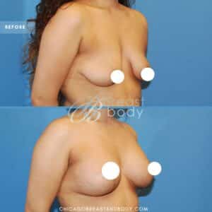 breast lift with implants before after photo by Anh-Tuan Truong Chicago Breast And Body Aesthetics