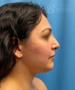 buccal fat removal cheek with chin liposuction by Dr. Kevin Lin Chicago Breast and Body Aesthetics