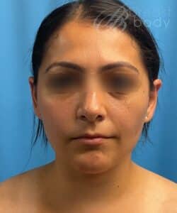 buccal fat removal cheek with chin liposuction by Dr. Kevin Lin Chicago Breast and Body Aesthetics - Case 63