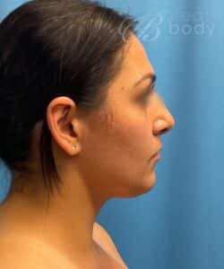 buccal fat removal cheek with chin liposuction by Dr. Kevin Lin Chicago Breast and Body Aesthetics