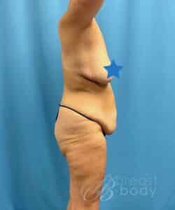 tummy tuck with back lift chicago breast and body case 61 1 2