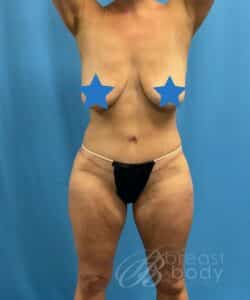 tummy tuck with back lift chicago breast and body case 61 2 1