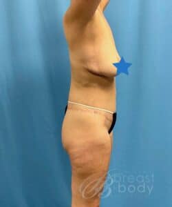 lower body lift before after with tummy tuck - Kevin Lin MD - Chicago Breast & Body Aesthetics
