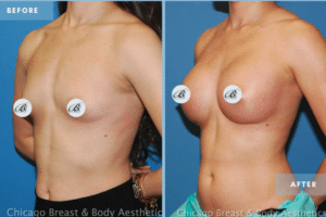 Are breast implants safe? Chicago Breast and Body Aesthetics