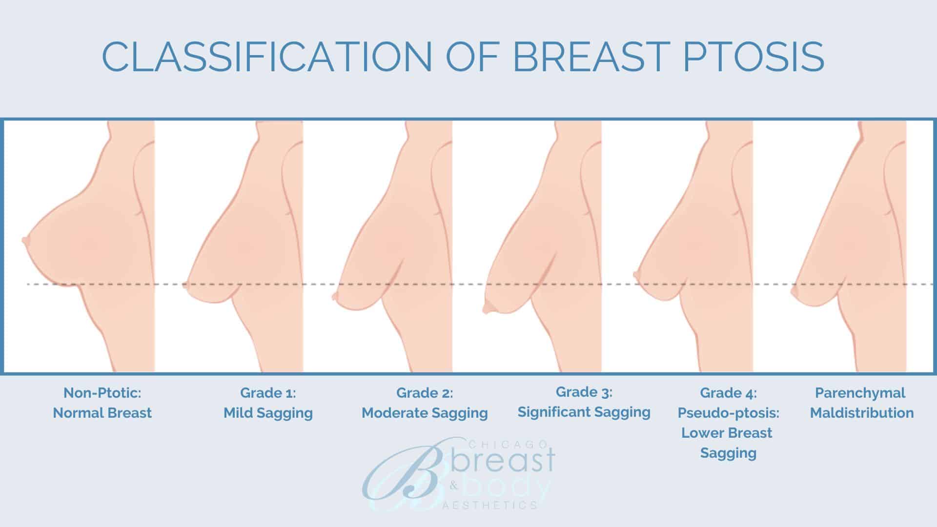 What is breast ptosis and breast ptosis classification