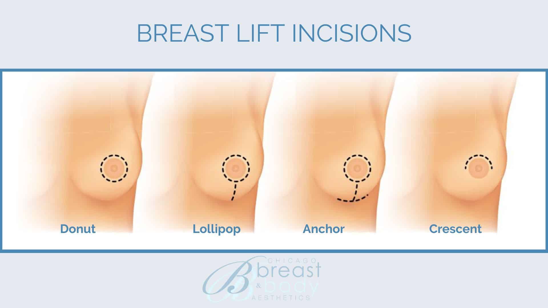 Types of breast lift incisions