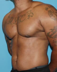 bodybuilder gynecomastia before after 57 Chicago Breast and Body Case 10 4
