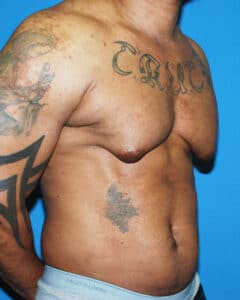 bodybuilder gynecomastia before after 57 Chicago Breast and Body Case 10 5