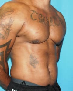 bodybuilder gynecomastia before after 57 Chicago Breast and Body Case 10 6