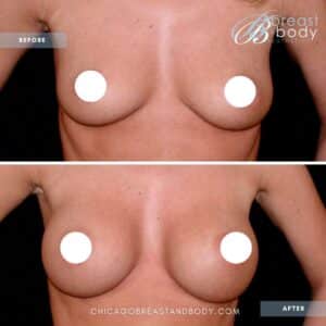breast augmentation before after by Dr. Francine Vagotis - Chicago Breast and Body Aesthetics