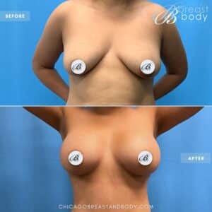 Breast implant placement breast augmentation before after by Dr. Kevin Lin