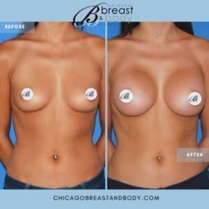 breast augmenation recovery