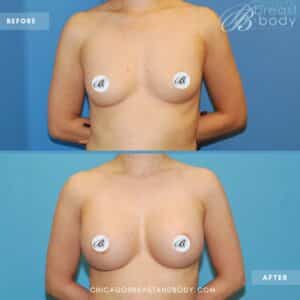 Breast augmentation before after by Dr. Anh Tuan Truong Chicago Breast and Body