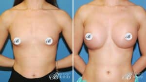 silicone or saline implants 1