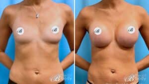 silicone or saline implants