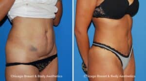 Mini Tummy Tuck1 Before After1