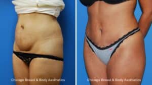 Mini Tummy Tuck1 Before After Photo by Dr. Anh Tuan Truong Chicago Breast & Body Aesthetics