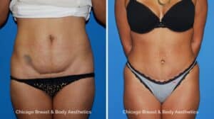 Mini Tummy Tuck1 Before After Photo by Dr. Anh Tuan Truong Chicago Breast & Body Aesthetics