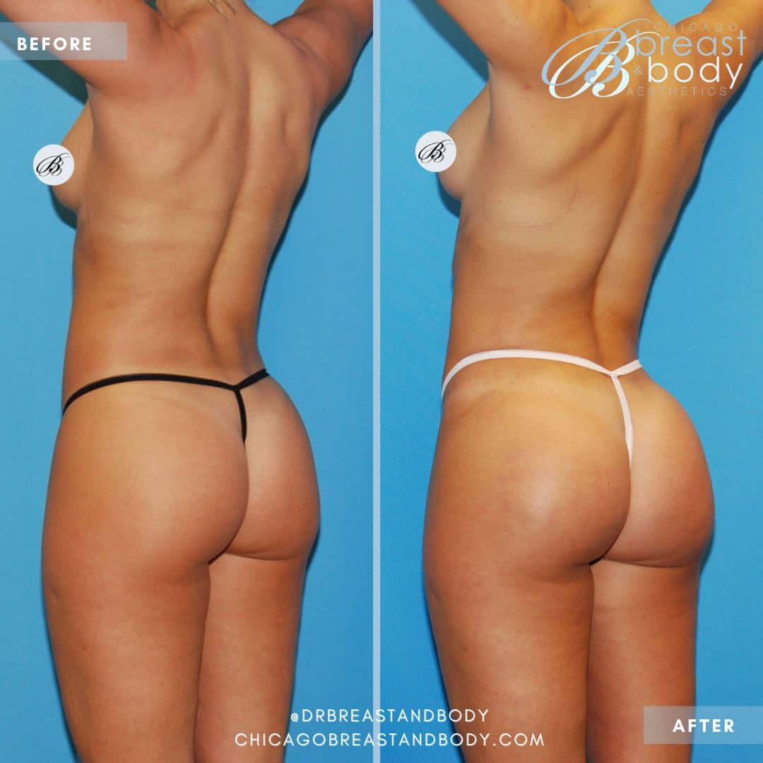 Getting a Brazilian Butt Lift? Ask These 5 Questions First