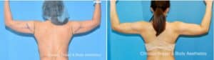 armsculpt arm liposuction before after case 250 chicago breast and body aesthetics