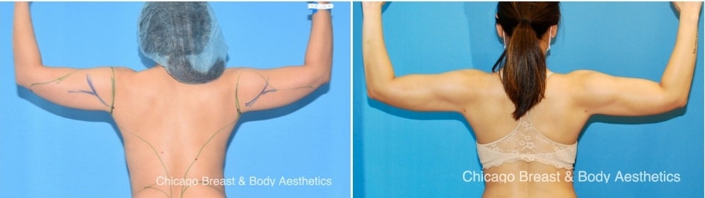 Arm Lipo Before and After Photo Case# 250 - Chicago Breast And Body Aesthetics