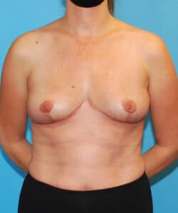 Breast Implant Removal Before After Photo Case 741 by Dr. Anh-Tuan Truong Chicago Breast & Body Aesthetics