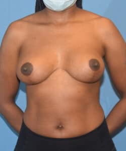 Breast Implant Removal Before After Photo Case 742 by Dr. Anh-Tuan Truong Chicago Breast & Body Aesthetics