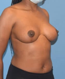 Breast Implant Removal Before After Photo Case 742 by Dr. Anh-Tuan Truong Chicago Breast & Body Aesthetics