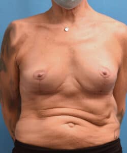 Breast Implant Removal Before After Photo Case 940 by Dr. Kevin Lin Chicago Breast & Body Aesthetics