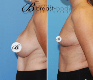 breast implant removal before after case 741 Chicago breast and body aesthetics