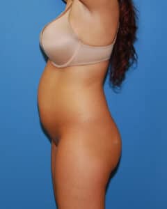 hip augmentation brazilian15 case748 chicago breast and body1