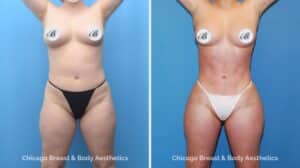 Hip widening surgery before after photo by Chicago Breast and Body