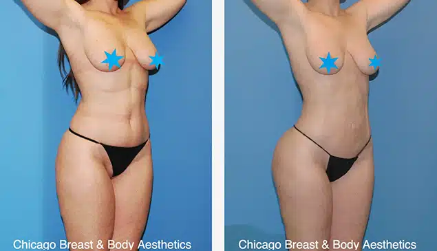 hip-widening-surgery-before-after-case-747-chicago-breast-and-body1 copia