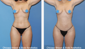 hip widening surgery before after case 747 chicago breast and body aesthetics