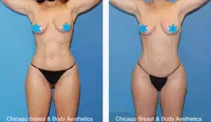 hip widening surgery before after case 747 chicago breast and body2 copia