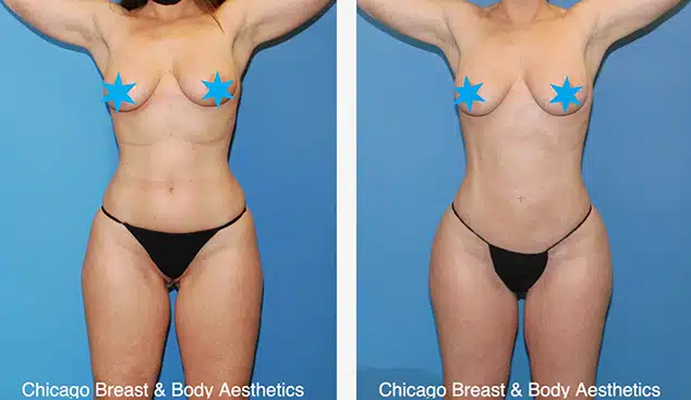 I'm a healthy 22-year-old woman with an athletic shape I would like to know  if I can get a BBL & silicon hip implants? (Photos)
