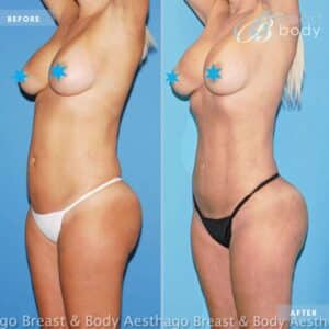 Renuvion Jplasma abdomen before after photo by Chicago Breast and Body