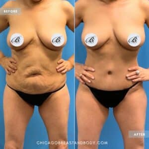 tummy tuck abdominoplasty before after photo by drbreastandbody