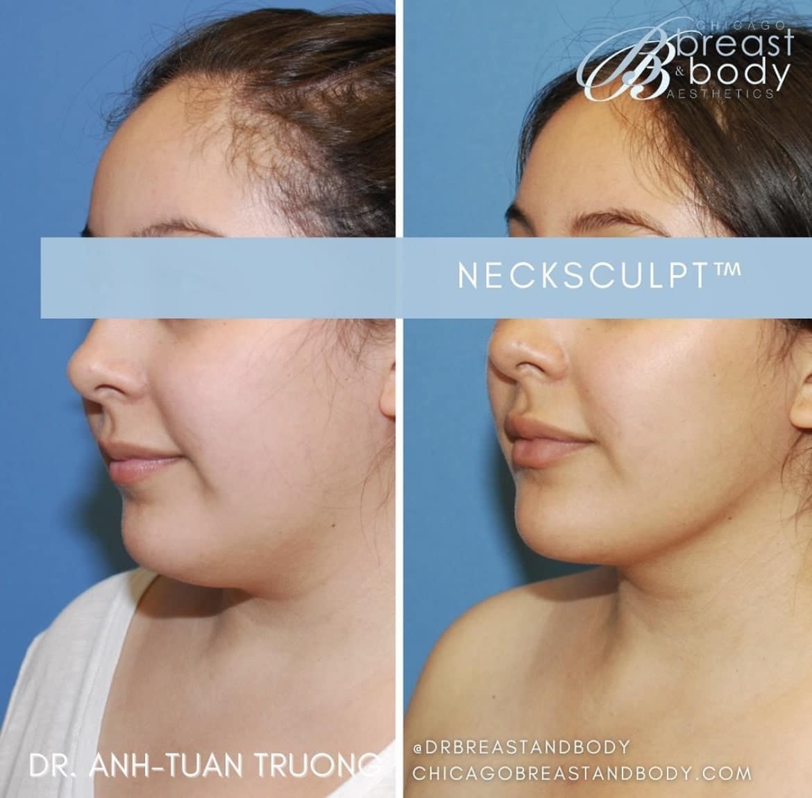 neck-sculpt-neck-liposuction-surgery-before-after-results-chicago-breast-and-body-aesthetics