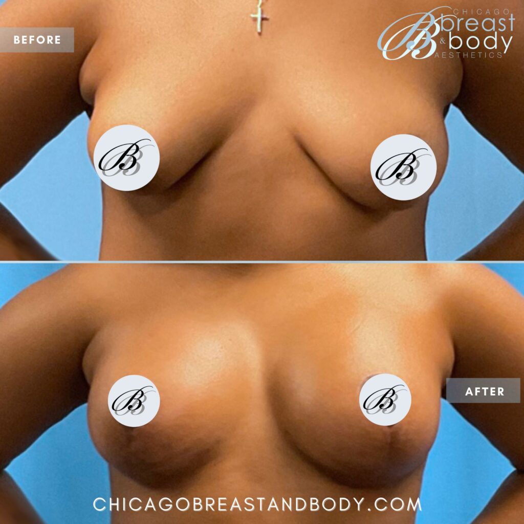breast augmentation before after photo by chicago breast and body aesthetics
