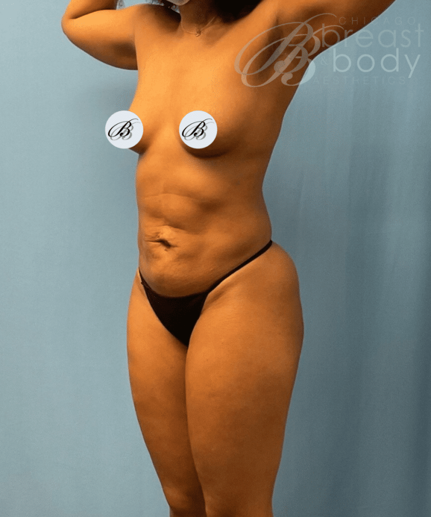 case-1041-liposuction-before-after-photos-dr-kevin-lin-chicago-breast-and-body