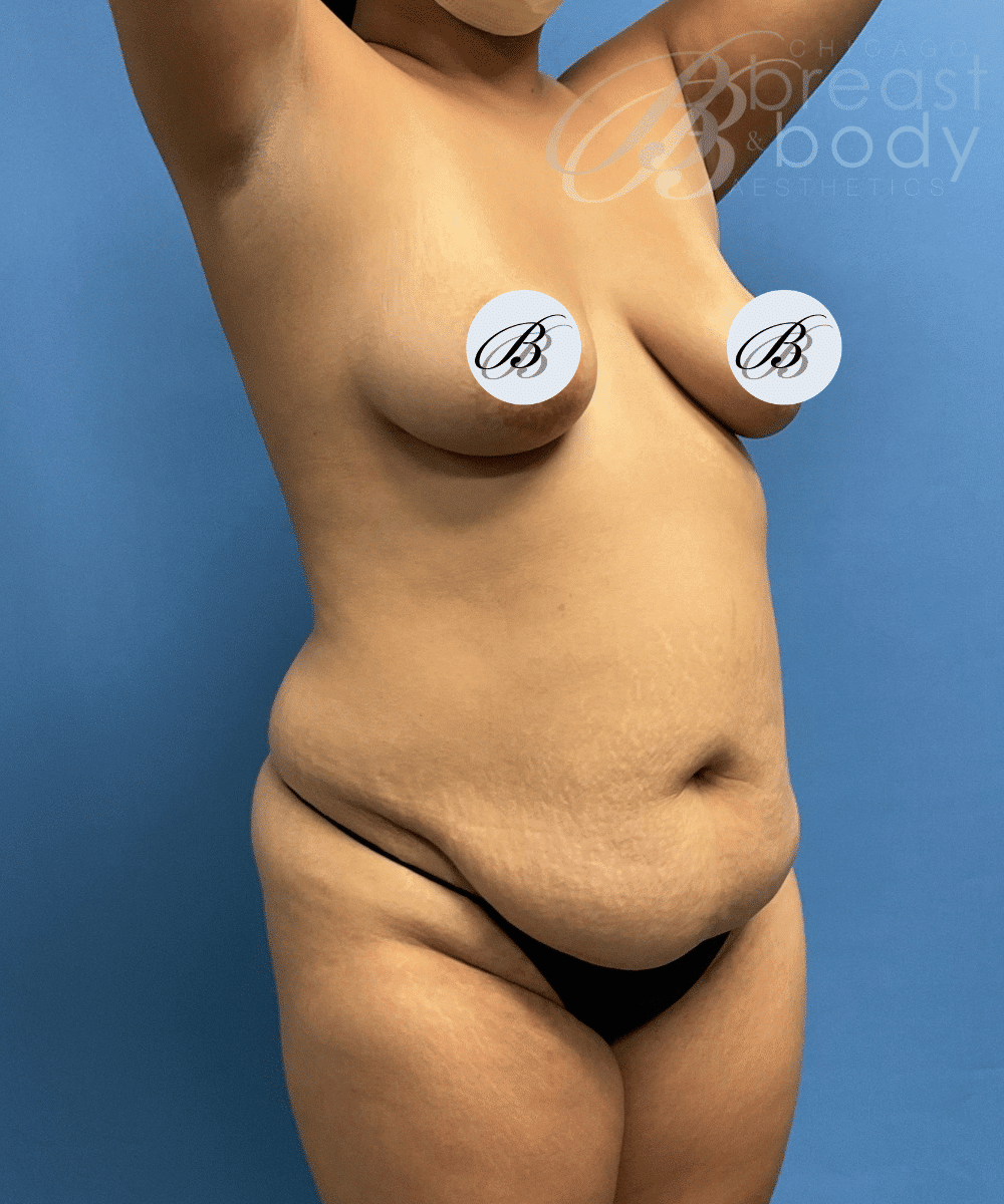 Brazilian Butt Lift, Lipo 360, Liposuction before photo 5, case #1751653, Dr. Kevin Lin, Chicago Breast & Body
