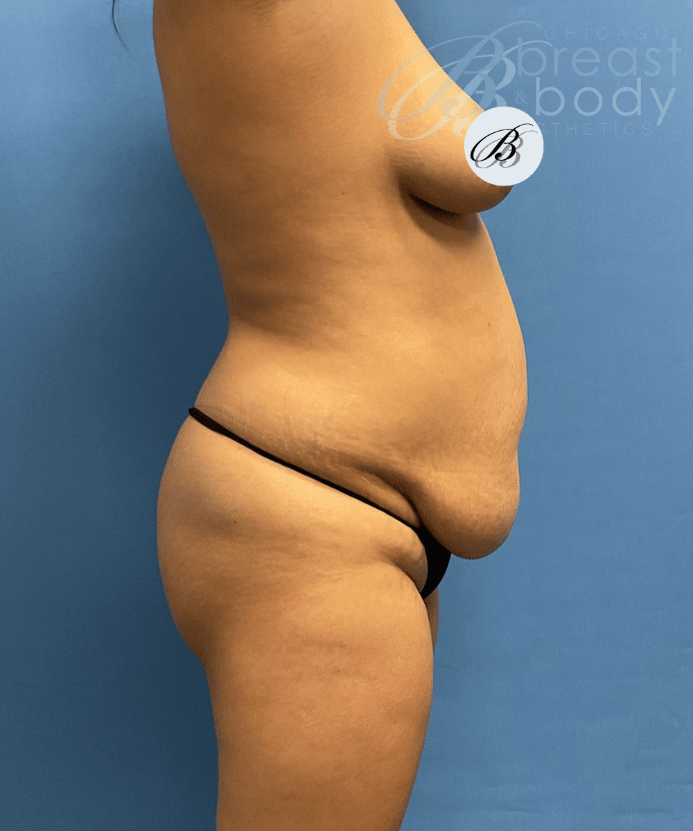 Brazilian Butt Lift, Lipo 360, Liposuction before photo 2, case #1751653, Dr. Kevin Lin, Chicago Breast & Body
