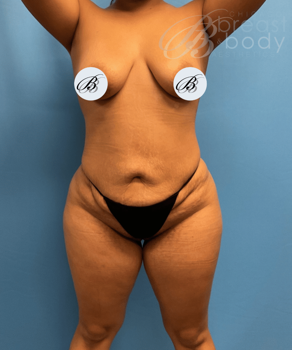 Brazilian Butt Lift, Lipo 360, Liposuction after photo 4, case #1751653, Dr. Kevin Lin, Chicago Breast & Body