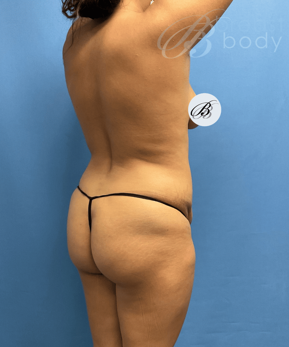 Brazilian Butt Lift, Lipo 360, Liposuction before photo 1, case #1751653, Dr. Kevin Lin, Chicago Breast & Body